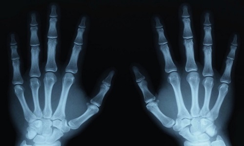 Снимок рентгенографии кистей